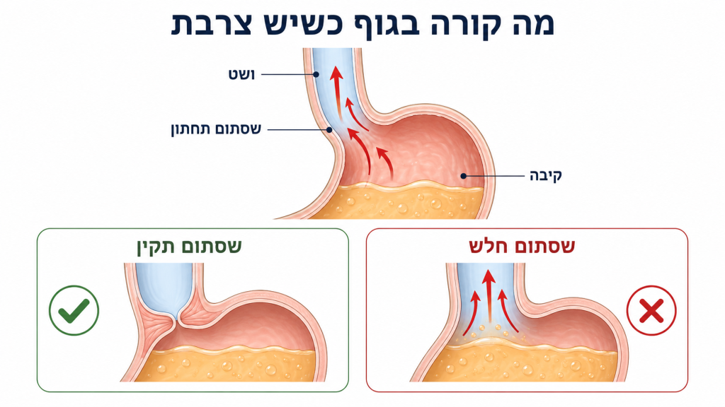עליית תוכן הקיבה לוושט דרך הסוגר הוושטי התחתון